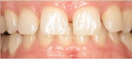 Invisalign before photo