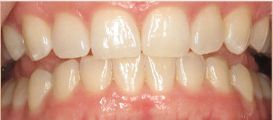 Invisalign after photo
